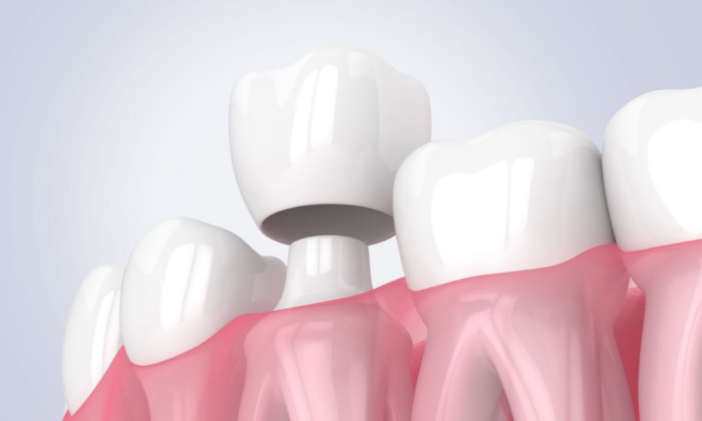 Dental Crowns