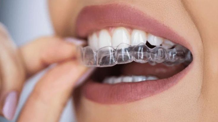 Invisalign aligners treatment at Dentique dental clinic,