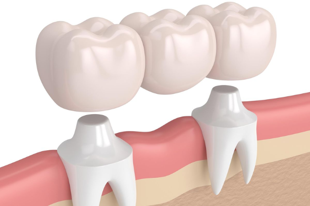 Dental Crowns & Bridges