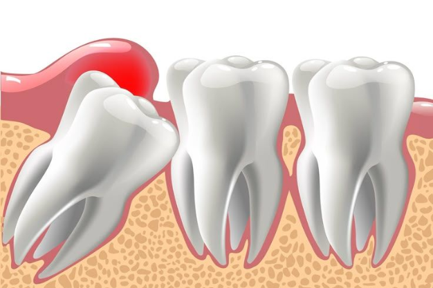 Wisdom Tooth