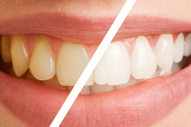 Teeth Cleaning & Polishing