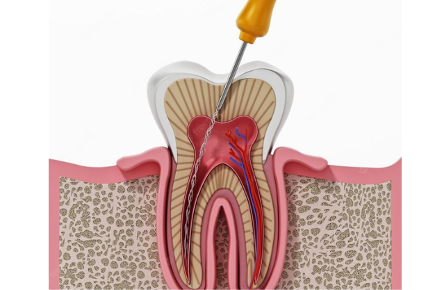 Root Canal