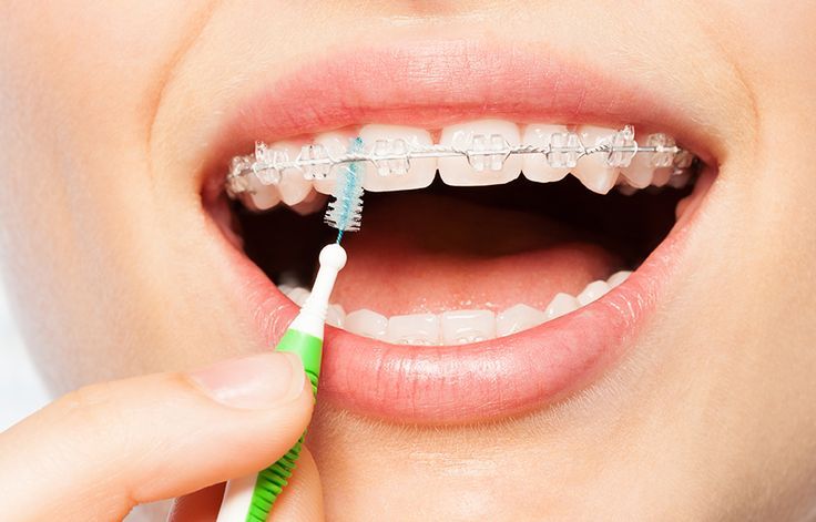 Braces Treatment in Wakad | Straighten Your Smile with Confidence & Care Braces treatment at Dentique Dental Clinic Wakad – metal, ceramic, and clear aligners for straight teeth and confident smiles