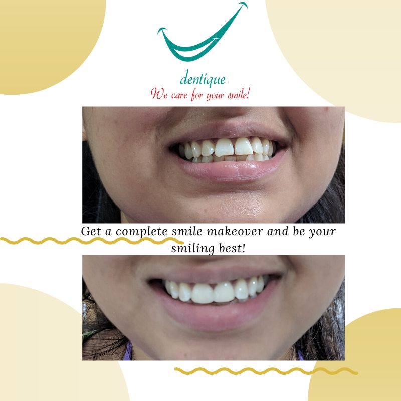 Before and after a smile makeover at Dentique, Wakad
