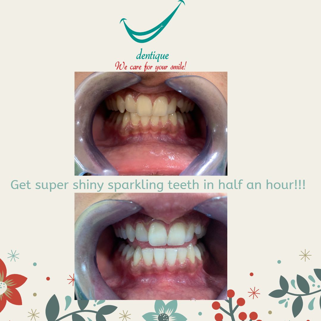 Teeth before and after professional whitening at Dentique, Wakad