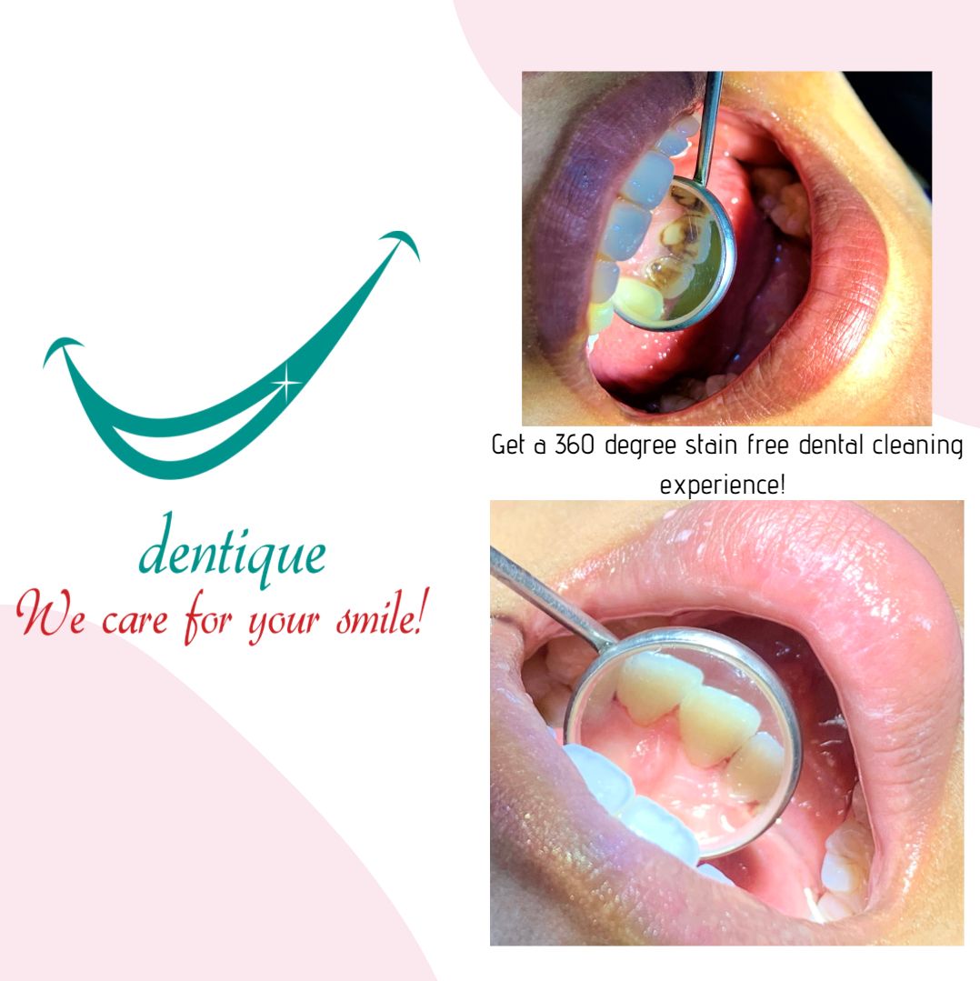 Dental check-up and cleaning at Dentique, Wakad