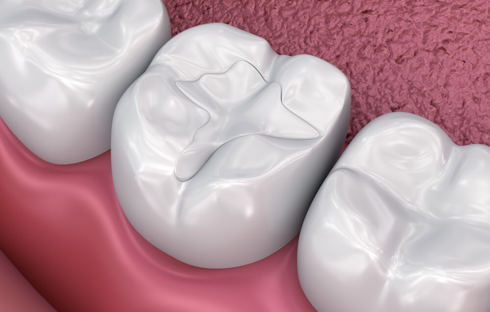 Illustration of a healthy back tooth with a protected chewing surface