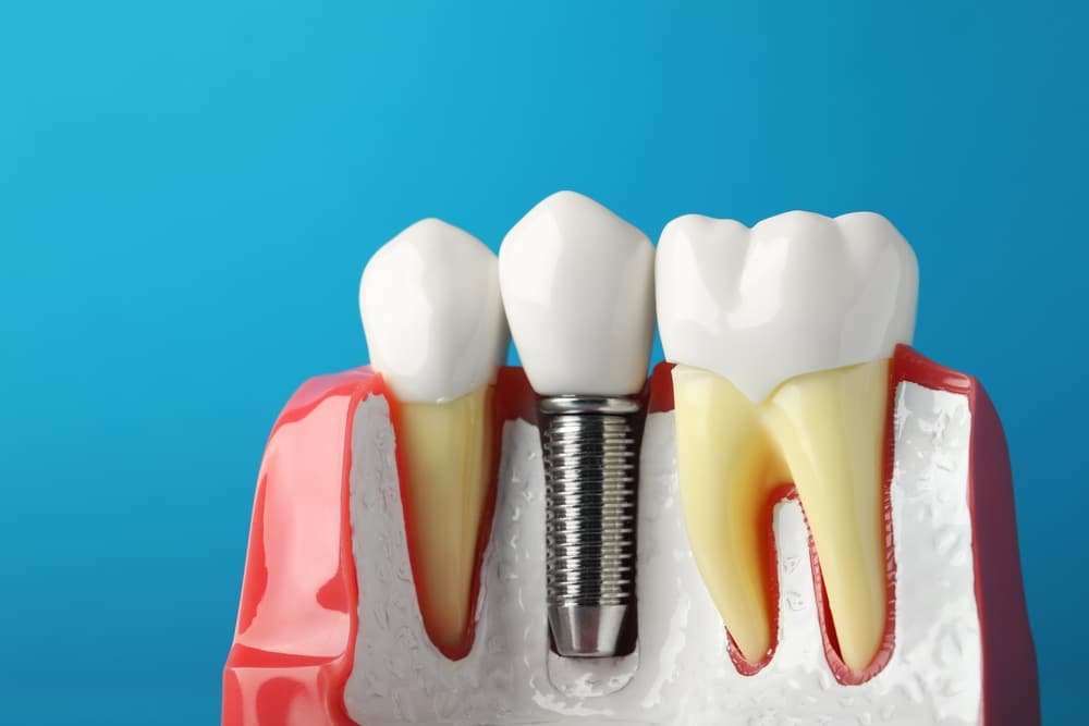 Illustration of a dental implant planned with digital tools