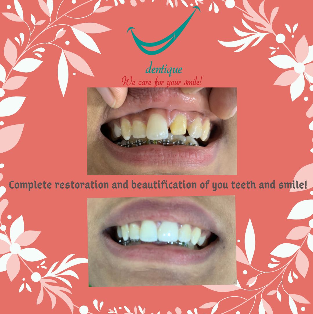 Before and after a dental restoration at Dentique, Wakad
