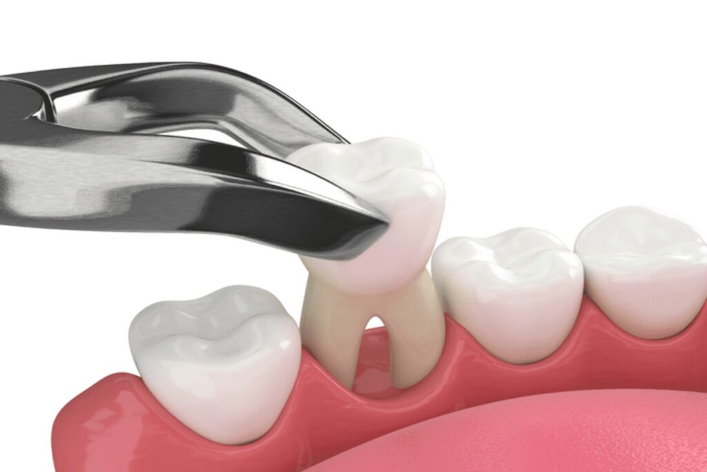 Illustration of an infected tooth being treated