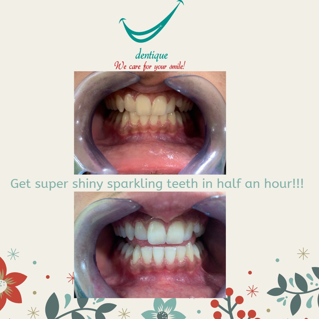 Teeth Whitening and Teeth Cleaning at Dentique .Dentique is the Best Dental clinic in Wakad. Dentique is the Best Dentist in Wakad