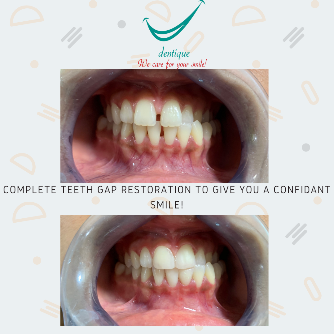 Teeth gap restoration at Dentique .Dentique is the Best Dental clinic in Wakad. Dentique is the Best Dentist in Wakad