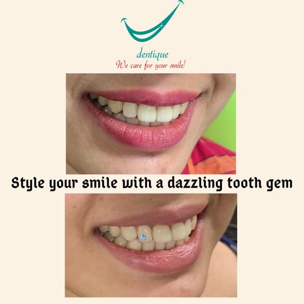 Tooth gem application at Dentique, Wakad