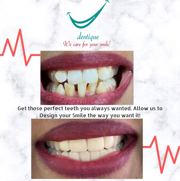Smile design result at Dentique, Wakad