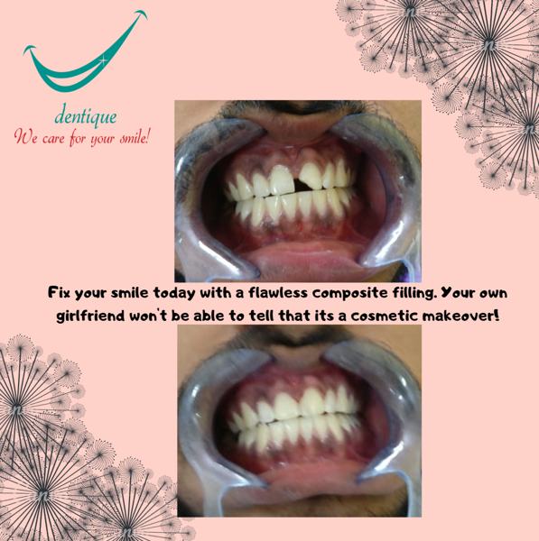 Tooth-coloured dental filling at Dentique, Wakad