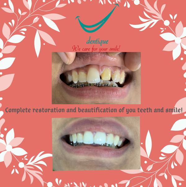 Orthodontic restoration at Dentique, Wakad
