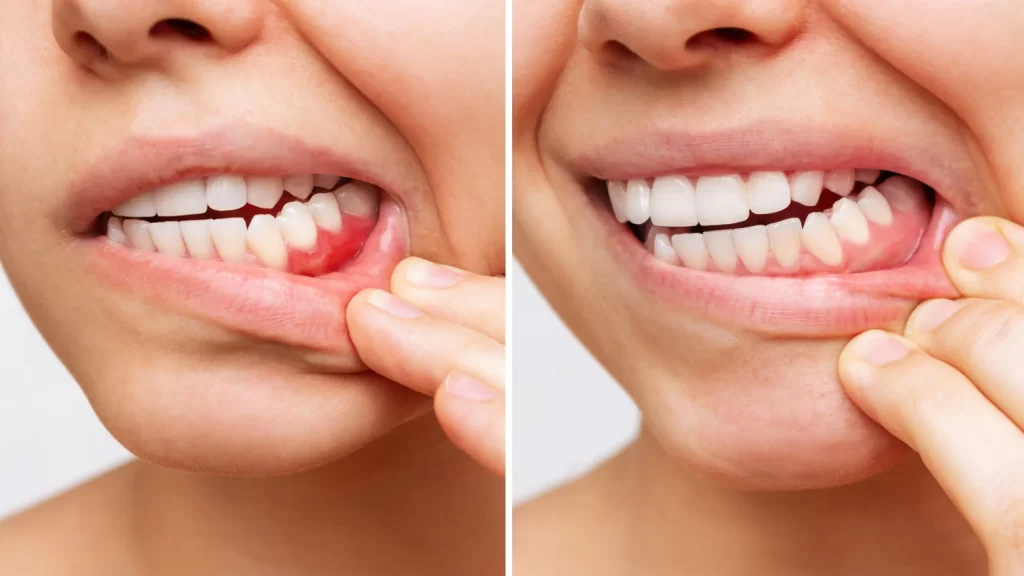 Comparison showing inflamed gums affected by gum disease and healthy gums after treatment
