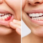 Comparison showing inflamed gums affected by gum disease and healthy gums after treatment