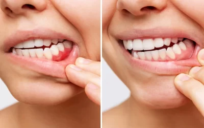Comparison showing inflamed gums affected by gum disease and healthy gums after treatment