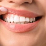 Healthy pink gums supporting strong white teeth for a confident smile