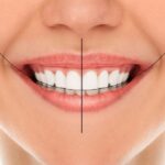 Digital smile design showing before and after preview of a patient smile