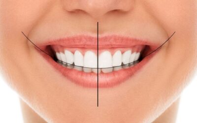 Digital smile design showing before and after preview of a patient smile