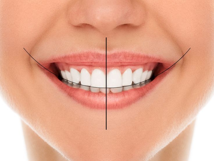 Digital smile design showing before and after preview of a patient smile