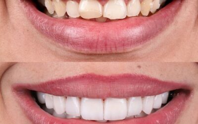 Teeth whitening before and after results for brighter smile