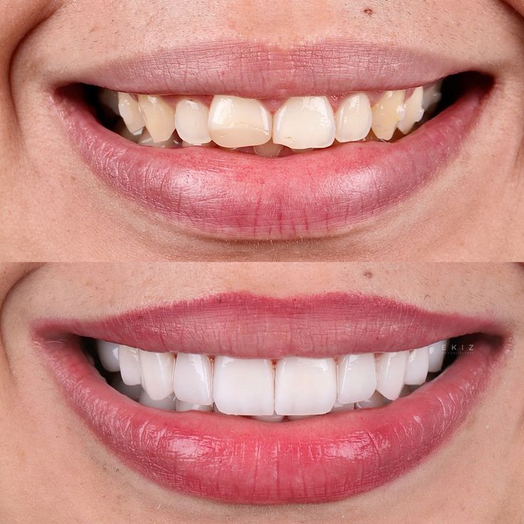 Teeth whitening before and after results for brighter smile
