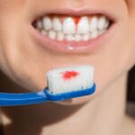 Bleeding gums while brushing teeth sign of gum disease
