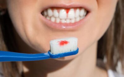 Bleeding gums while brushing teeth sign of gum disease