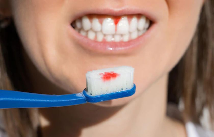 Bleeding gums while brushing teeth sign of gum disease